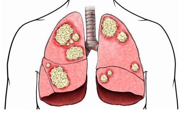 新的联合疗法显示出对某些肺癌的早期希望 第1张