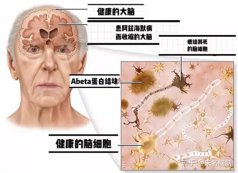 提前 17 年发现早期阿尔茨海默病 第1张