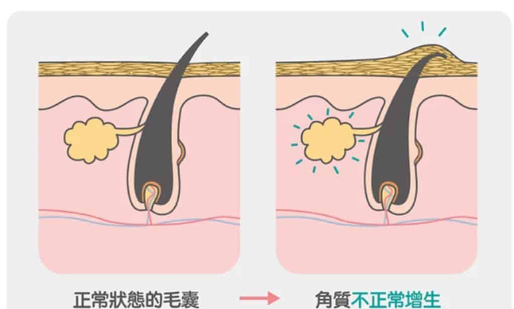 控制毛囊生死的化学物质 第1张