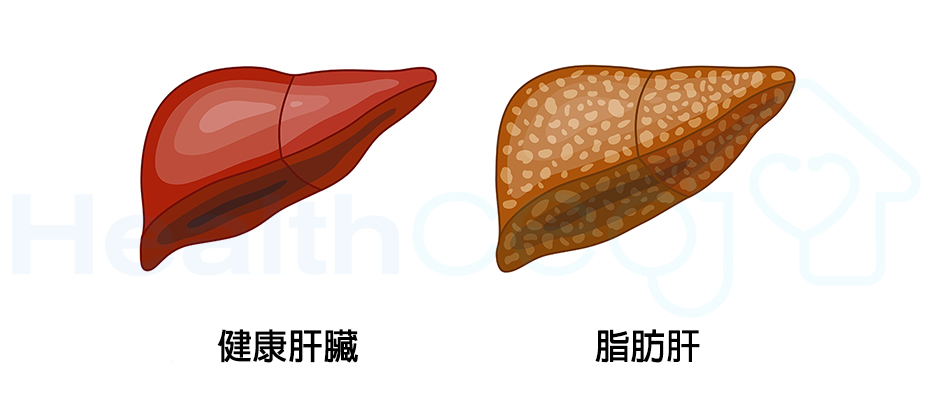 睡眠不良的人可能有患脂肪肝的风险 第1张