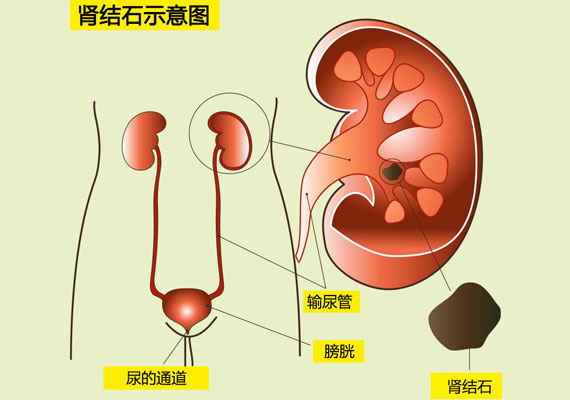 富含钙和钾的饮食可能有助于预防症状性肾结石的复发 第1张