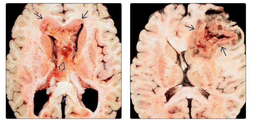 脑肿瘤3D模型的建立有助于个性化治疗 第1张