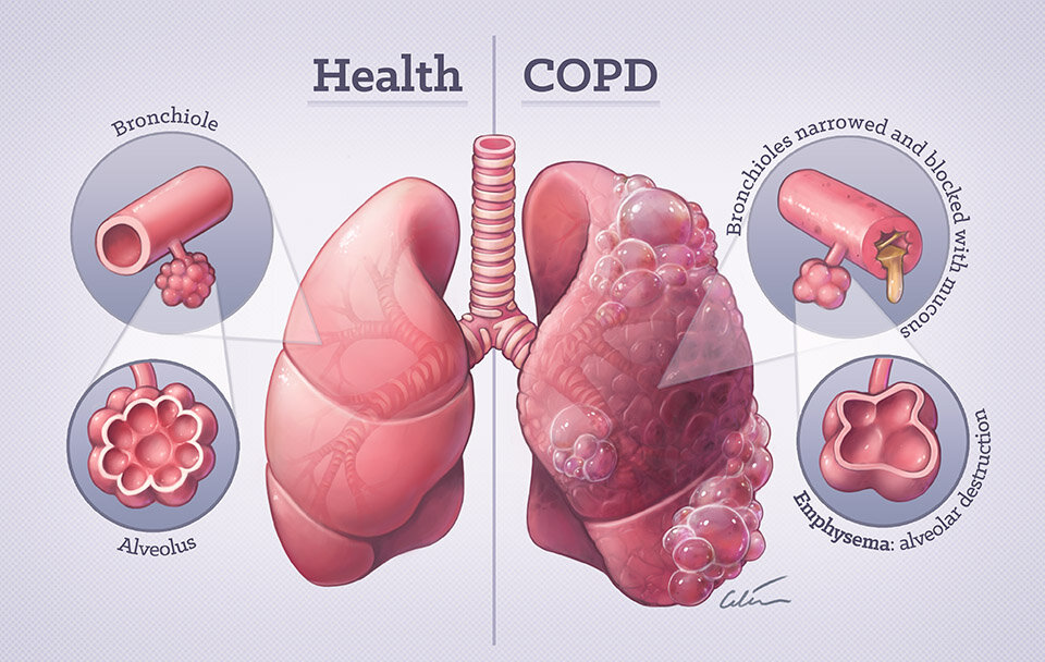 较小的气道会增加女性患COPD的风险 第1张