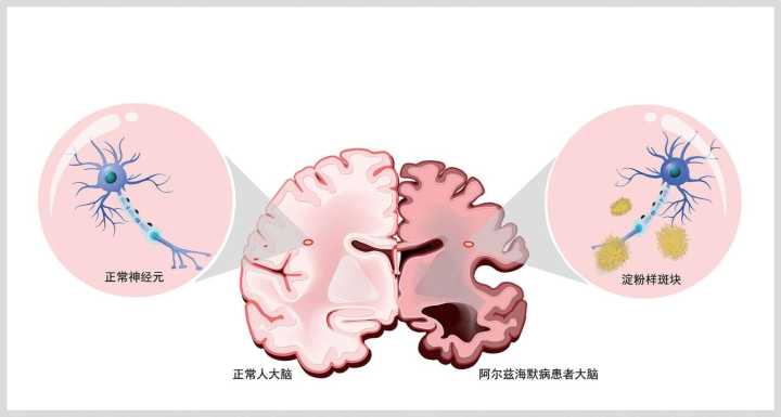 小胶质细胞如何导致阿尔茨海默病 第1张