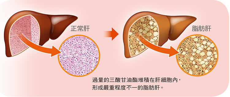 B族维生素可用于治疗晚期非酒精性脂肪肝 第1张